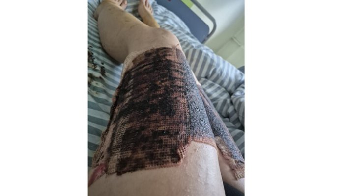 Control la Spitalul Floreasca, după scrisoarea deschisă a unei ploieștence internate acolo împreună cu sora sa: „Domnule ministru, dădusem deja pielea de pe mine!”